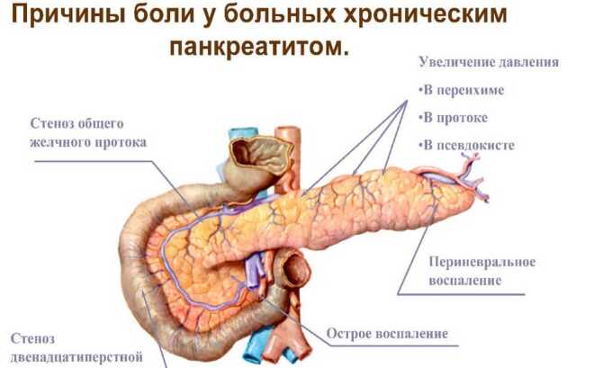 Течение хронического панкреатита сопровождается изменениями в клеточной структуре железы, нарушением секреции пищеварительных ферментов