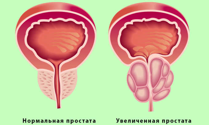 Если простата увеличена таблетки от панкреатита запрещены