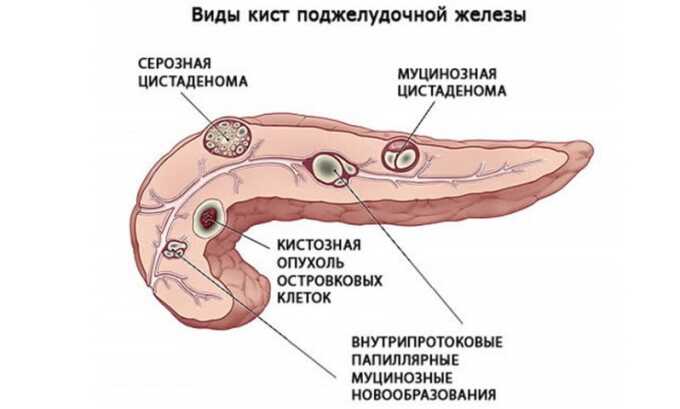 В зависимости от особенностей кист поджелудочной, симптомов и причин появления, их классифицируют на истинные (к ним относятся все врожденные образования и 2 вида приобретенных: полиферационные и ретенционные) и ложные