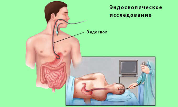 Эндоскопическое исследование помогает выбрать наиболее эффективную терапевтическую схему