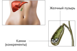 Желчнокаменная болезнь - причина панкреатита