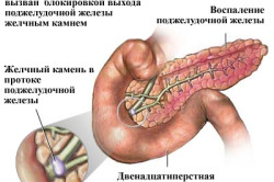 Причина возникновения индуративного панкреатита