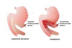 Панкреатит - воспаление поджелудочной железы