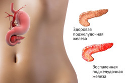Схема панкреатита