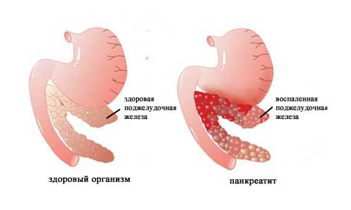 Схема панкреатита