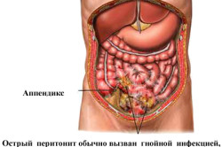 Перитонит - последствие панкреатита