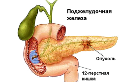Схема опухоли поджелудочной железы