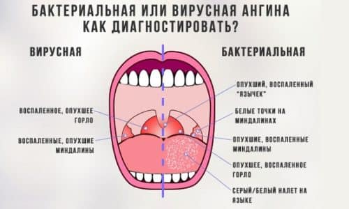 Сухость и горечь в горле может возникать при инфекционных заболеваниях, например, ангине