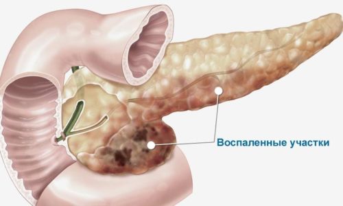 Поджелудочная железа вырабатывает ферменты, которые должны поступать в кишечник для осуществления процесса пищеварения, но застой секреции в полости железы вызывает раздражение слизистой оболочки