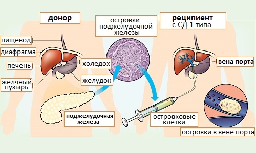 Схема проведения операции по пересадке поджелудочной железы