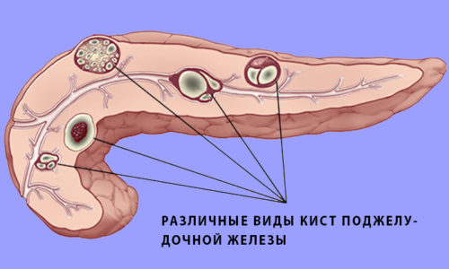 По месту расположения различают псевдокисты тела или хвоста железы. Новообразования бывают мелкими или крупными, единичными или множественными
