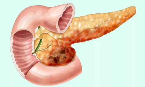 Большинству больным с панкреатитом строго запрещено потребление жиров, которые содержаться в орехах