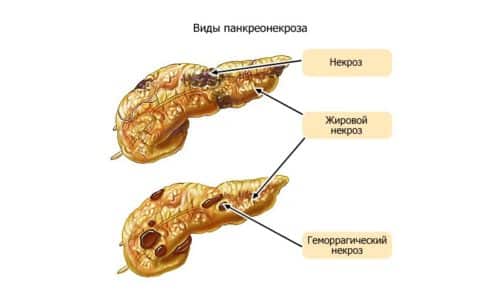 Сильно увеличивается поджелудочная железа при панкреонекрозе - разрушении тканей органа